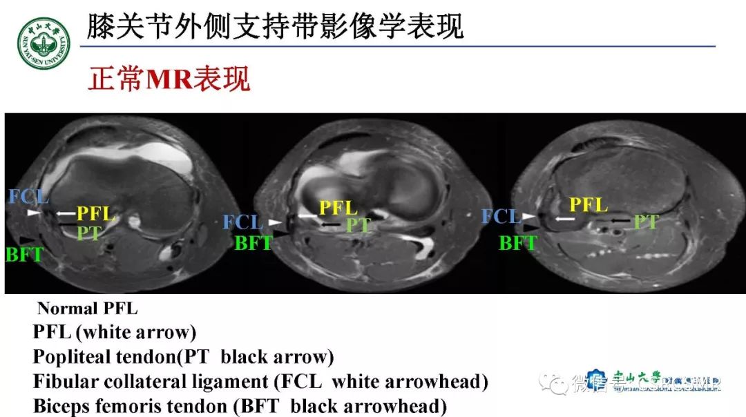 影像PPT - 【PPT】膝关节后外侧角区影像解剖及损伤后影像学诊断-16