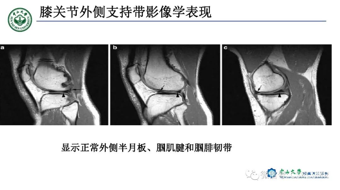 影像PPT - 【PPT】膝关节后外侧角区影像解剖及损伤后影像学诊断-17