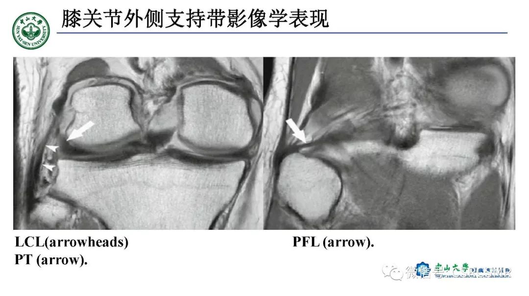 影像PPT - 【PPT】膝关节后外侧角区影像解剖及损伤后影像学诊断-18