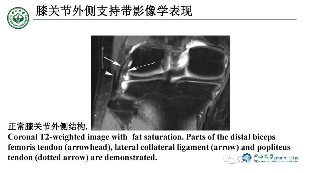 影像PPT - 【PPT】膝关节后外侧角区影像解剖及损伤后影像学诊断-19