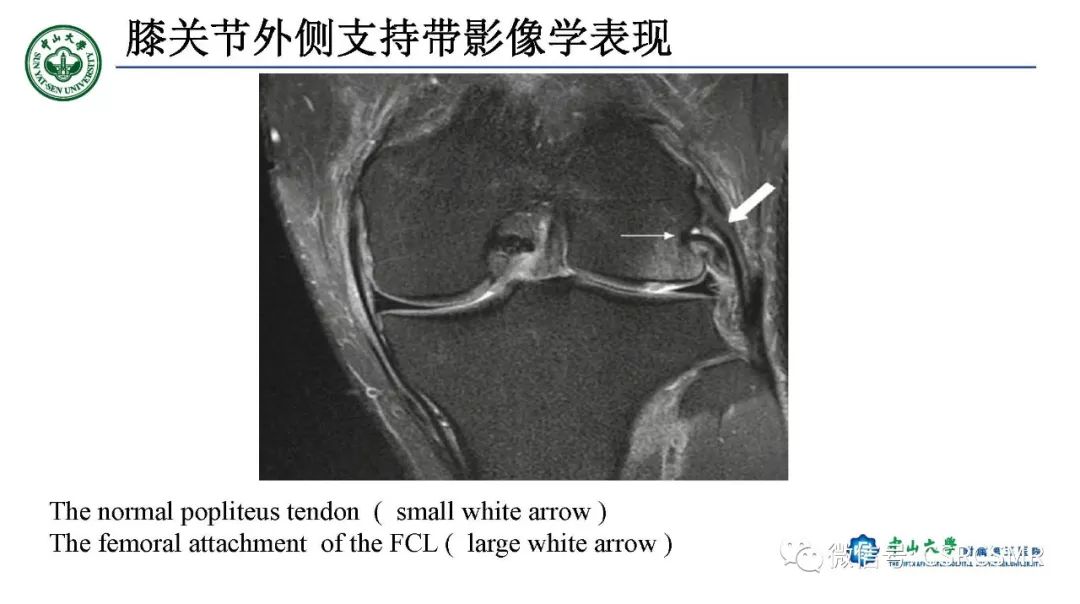 影像PPT - 【PPT】膝关节后外侧角区影像解剖及损伤后影像学诊断-20