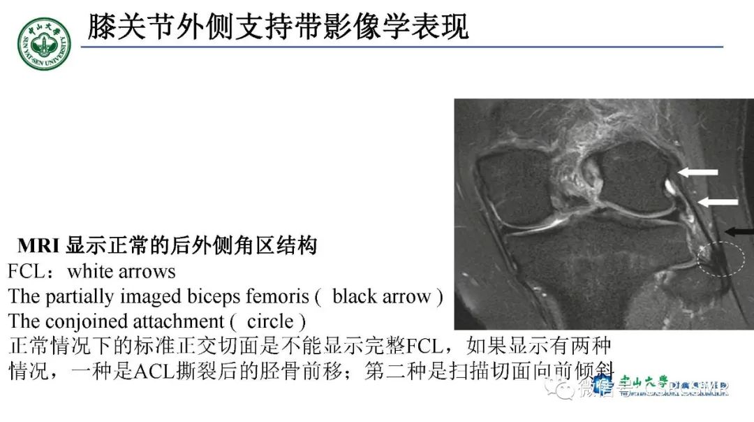 影像PPT - 【PPT】膝关节后外侧角区影像解剖及损伤后影像学诊断-21
