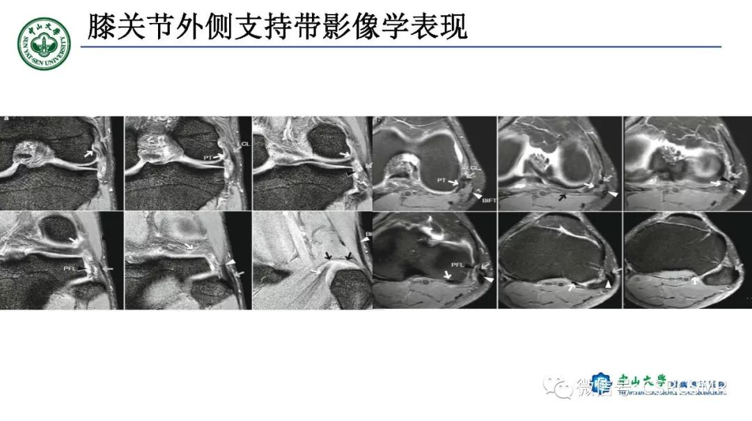 影像PPT - 【PPT】膝关节后外侧角区影像解剖及损伤后影像学诊断-22
