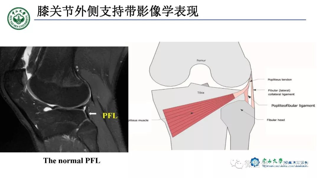 影像PPT - 【PPT】膝关节后外侧角区影像解剖及损伤后影像学诊断-23