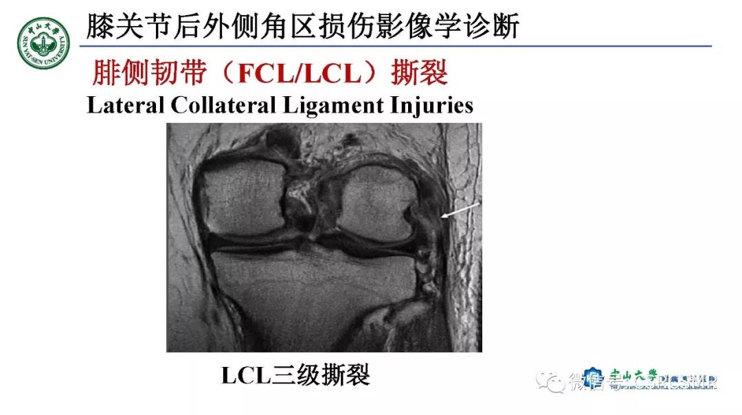 影像PPT - 【PPT】膝关节后外侧角区影像解剖及损伤后影像学诊断-26