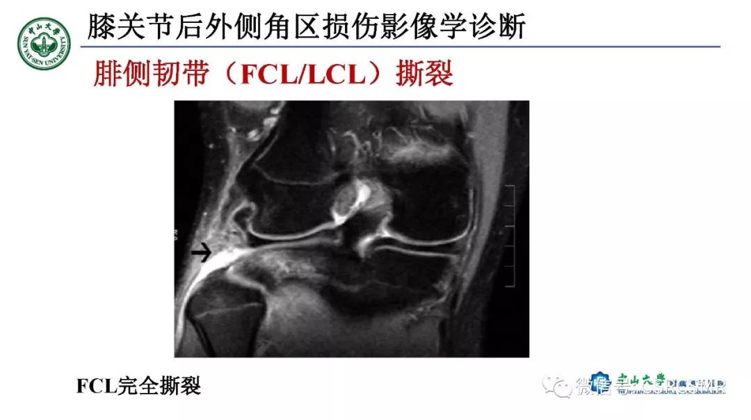 影像PPT - 【PPT】膝关节后外侧角区影像解剖及损伤后影像学诊断-27