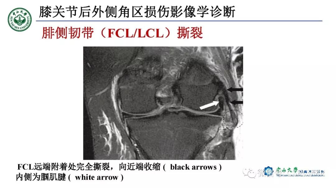 影像PPT - 【PPT】膝关节后外侧角区影像解剖及损伤后影像学诊断-28