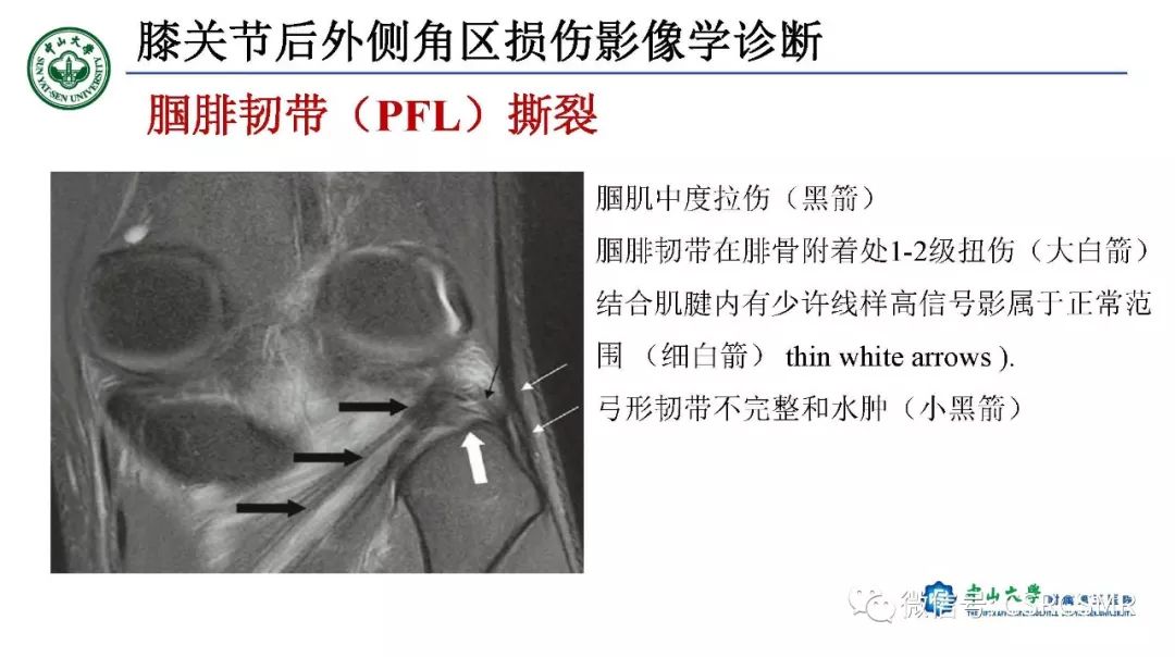 影像PPT - 【PPT】膝关节后外侧角区影像解剖及损伤后影像学诊断-29