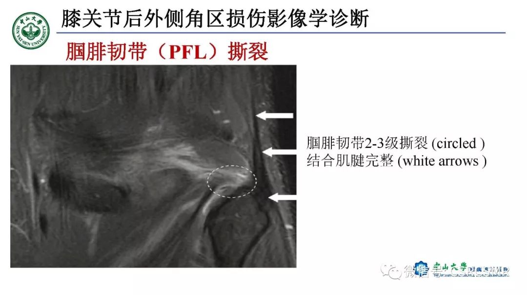 影像PPT - 【PPT】膝关节后外侧角区影像解剖及损伤后影像学诊断-30