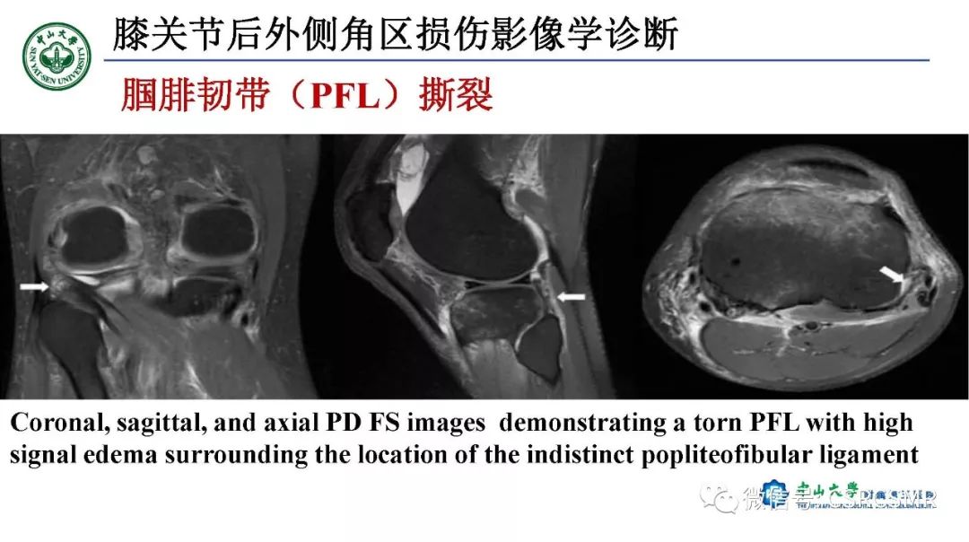 影像PPT - 【PPT】膝关节后外侧角区影像解剖及损伤后影像学诊断-31