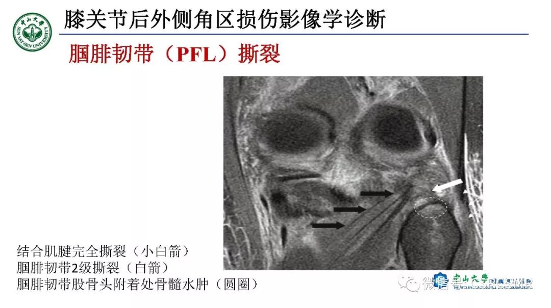 影像PPT - 【PPT】膝关节后外侧角区影像解剖及损伤后影像学诊断-32