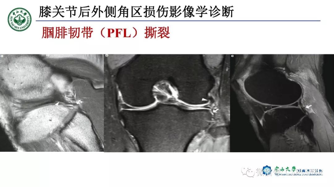 影像PPT - 【PPT】膝关节后外侧角区影像解剖及损伤后影像学诊断-33