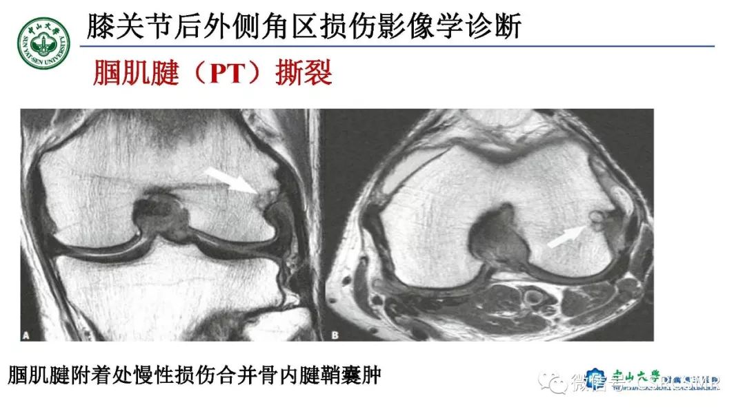 影像PPT - 【PPT】膝关节后外侧角区影像解剖及损伤后影像学诊断-34