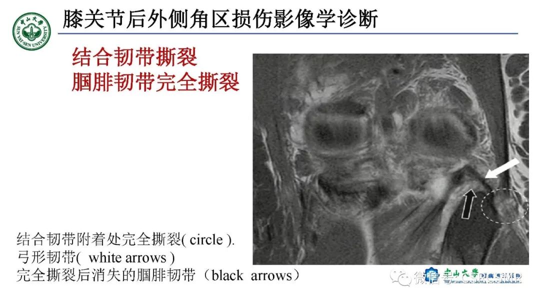 影像PPT - 【PPT】膝关节后外侧角区影像解剖及损伤后影像学诊断-35