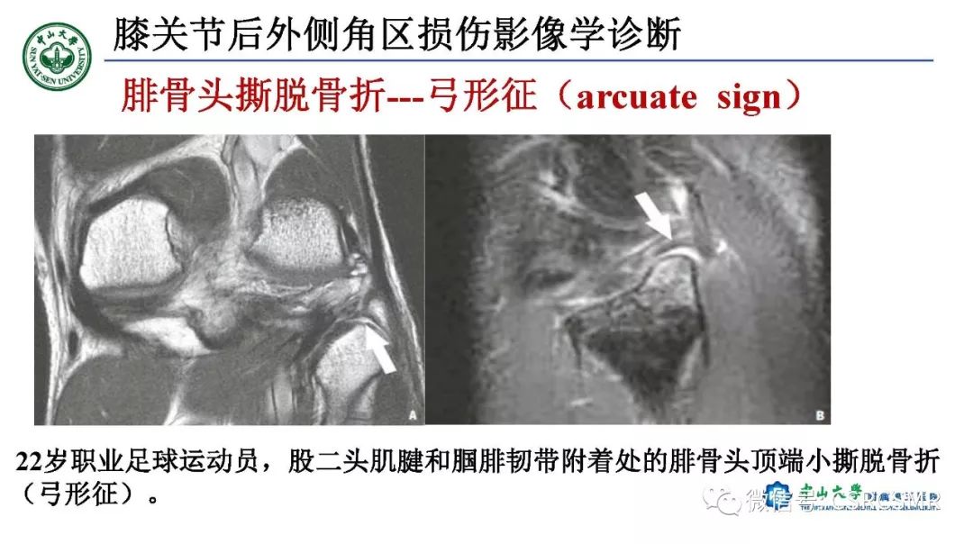 影像PPT - 【PPT】膝关节后外侧角区影像解剖及损伤后影像学诊断-38