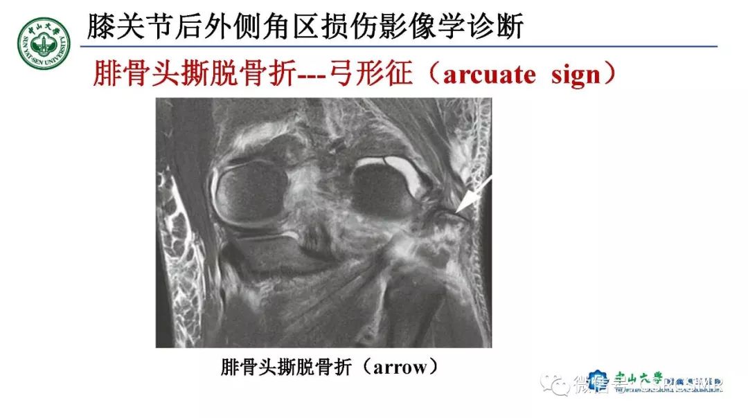 影像PPT - 【PPT】膝关节后外侧角区影像解剖及损伤后影像学诊断-39