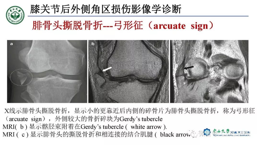 影像PPT - 【PPT】膝关节后外侧角区影像解剖及损伤后影像学诊断-40