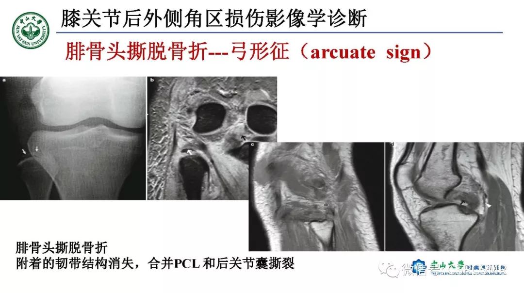 影像PPT - 【PPT】膝关节后外侧角区影像解剖及损伤后影像学诊断-41
