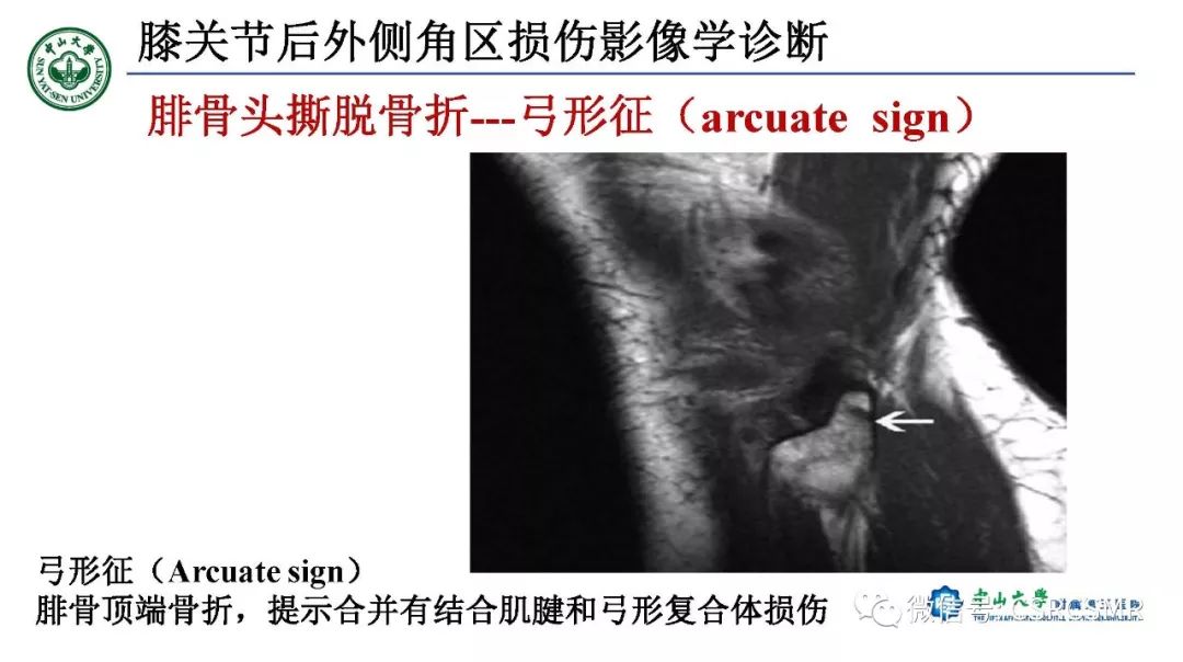 影像PPT - 【PPT】膝关节后外侧角区影像解剖及损伤后影像学诊断-42