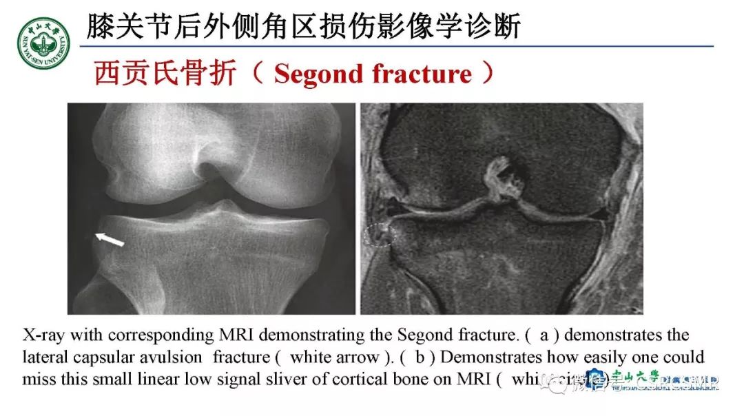 影像PPT - 【PPT】膝关节后外侧角区影像解剖及损伤后影像学诊断-45