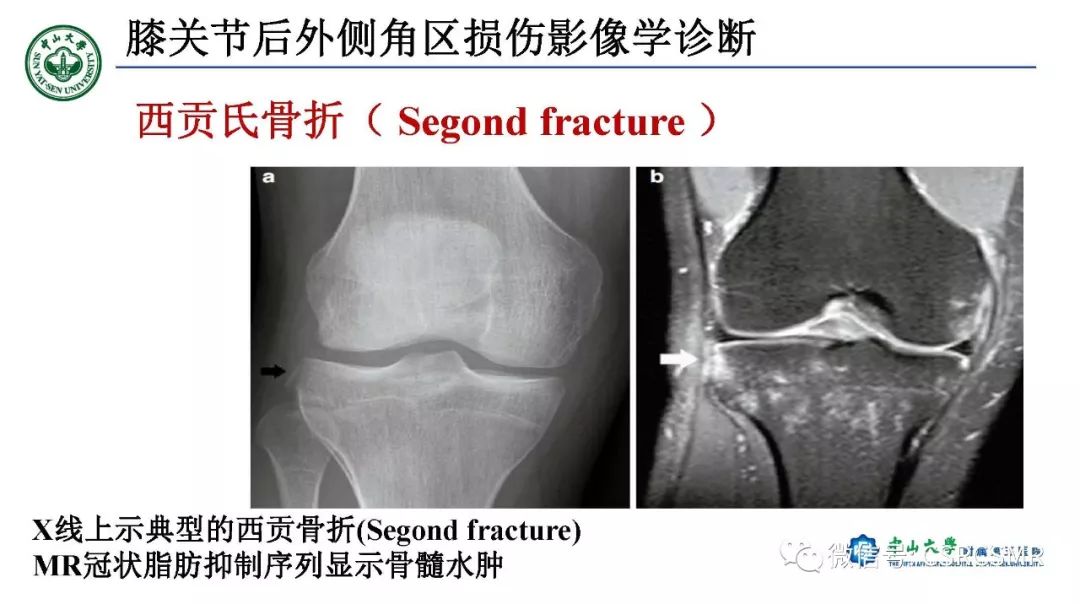 影像PPT - 【PPT】膝关节后外侧角区影像解剖及损伤后影像学诊断-46