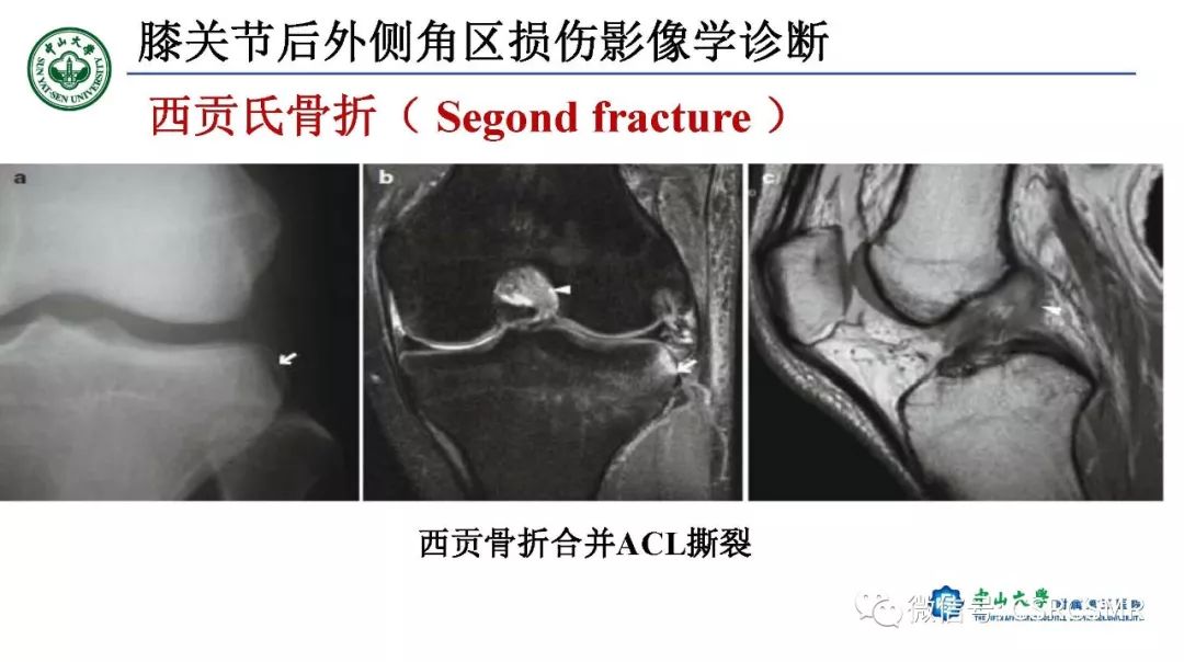 影像PPT - 【PPT】膝关节后外侧角区影像解剖及损伤后影像学诊断-47