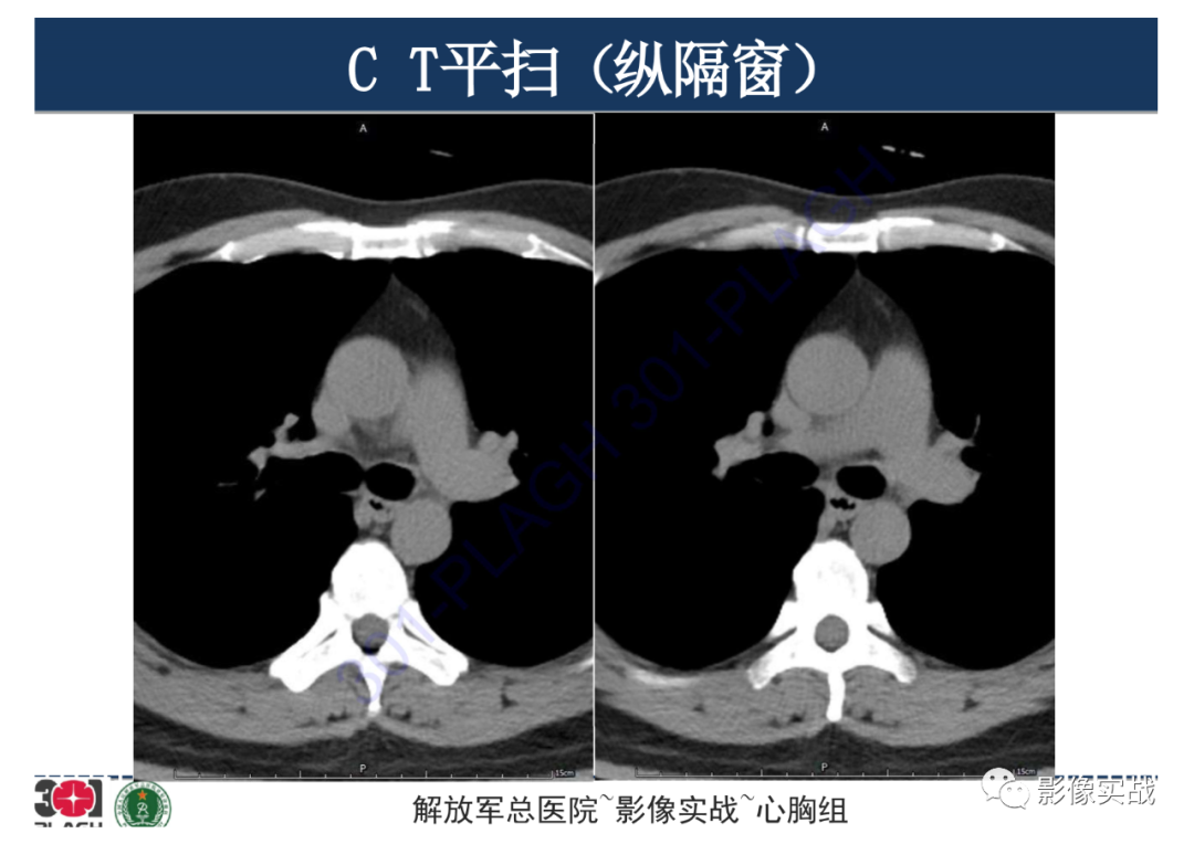 影像PPT - 【病例】支气管神经鞘瘤1例CT影像-7