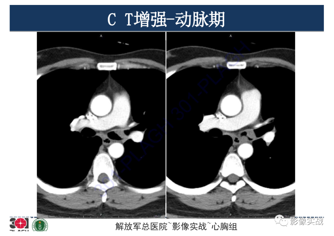 影像PPT - 【病例】支气管神经鞘瘤1例CT影像-12