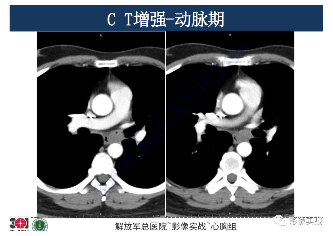 影像PPT - 【病例】支气管神经鞘瘤1例CT影像-13