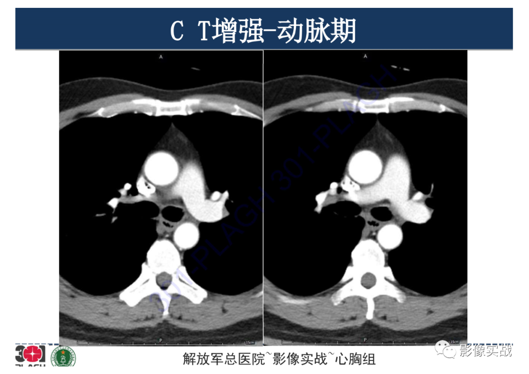 影像PPT - 【病例】支气管神经鞘瘤1例CT影像-11