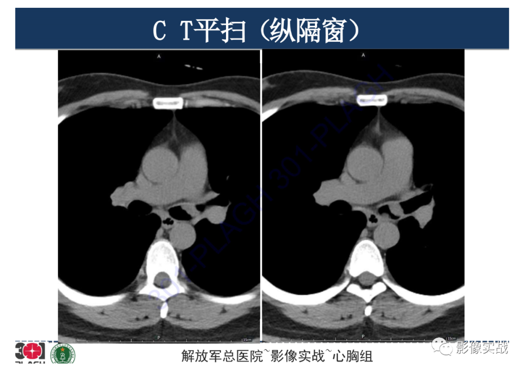 影像PPT - 【病例】支气管神经鞘瘤1例CT影像-8