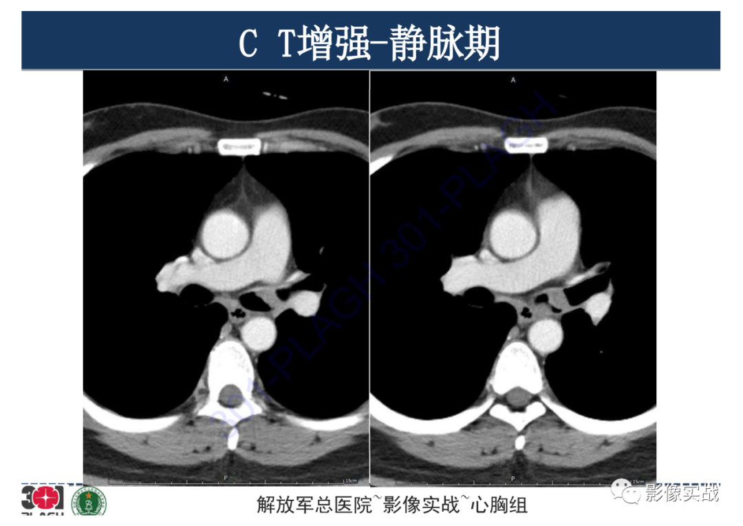 影像PPT - 【病例】支气管神经鞘瘤1例CT影像-16