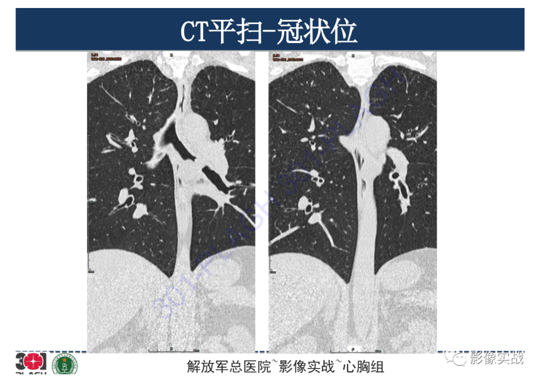 影像PPT - 【病例】支气管神经鞘瘤1例CT影像-20
