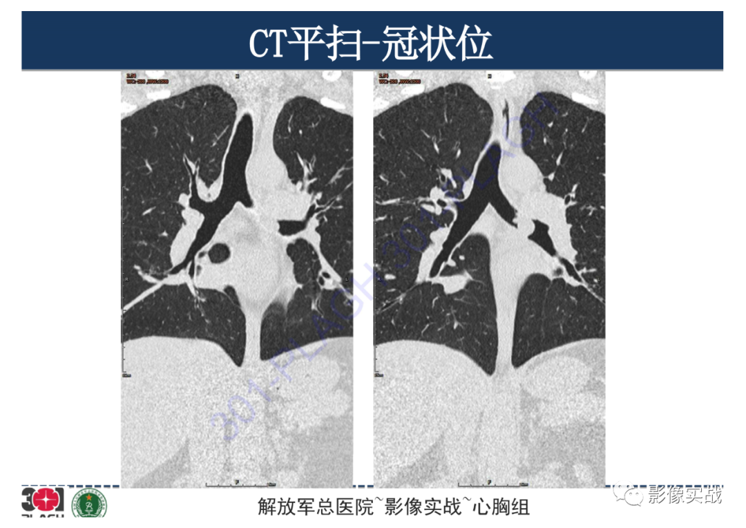 影像PPT - 【病例】支气管神经鞘瘤1例CT影像-19