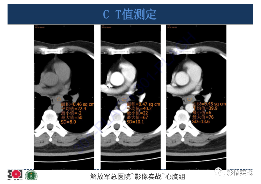 影像PPT - 【病例】支气管神经鞘瘤1例CT影像-21