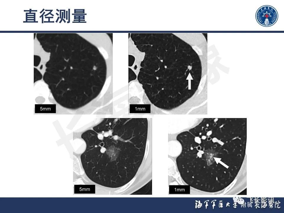 影像PPT - 【PPT】肺结节的CT定量测量-5
