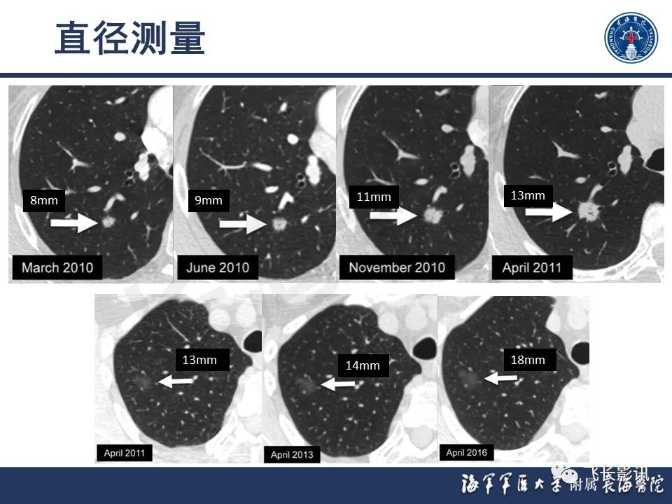 影像PPT - 【PPT】肺结节的CT定量测量-10