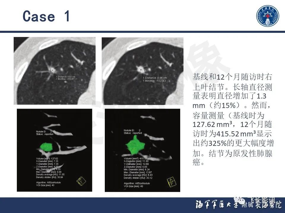 影像PPT - 【PPT】肺结节的CT定量测量-14