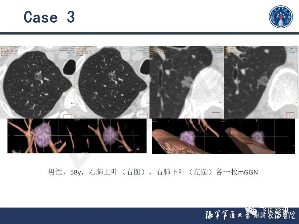 影像PPT - 【PPT】肺结节的CT定量测量-27
