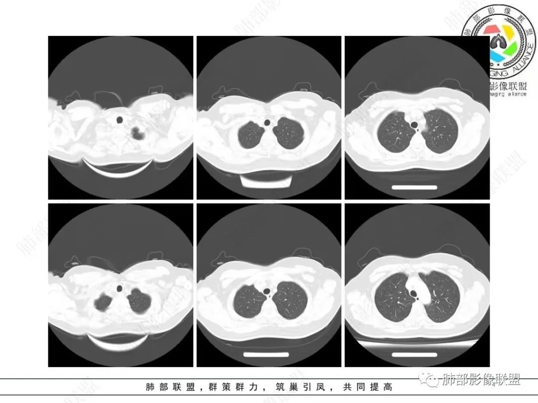 影像PPT - 【病例】 如此扮相的隐球菌,你敢诊断吗?-5 影像PPT - 【病例】 如此扮相的隐球菌,你敢诊断吗?-5
