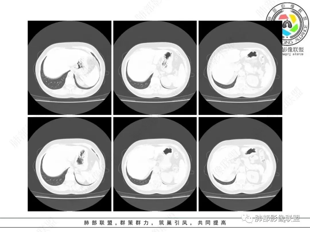 影像PPT - 【病例】 如此扮相的隐球菌,你敢诊断吗?-9 影像PPT - 【病例】 如此扮相的隐球菌,你敢诊断吗?-9