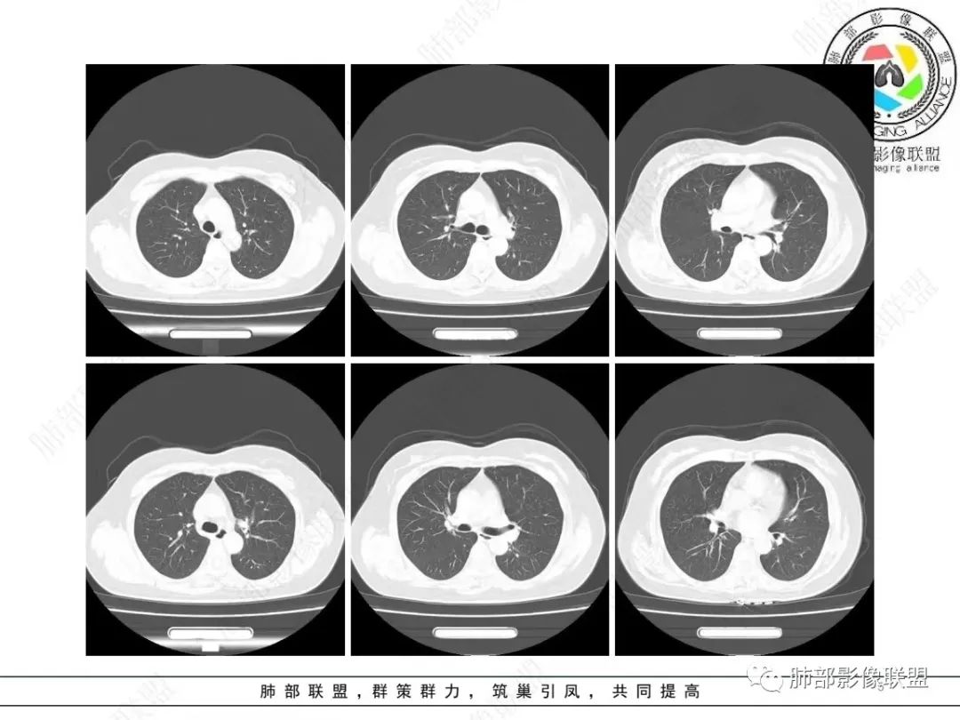 影像PPT - 【病例】 如此扮相的隐球菌,你敢诊断吗?-6 影像PPT - 【病例】 如此扮相的隐球菌,你敢诊断吗?-6