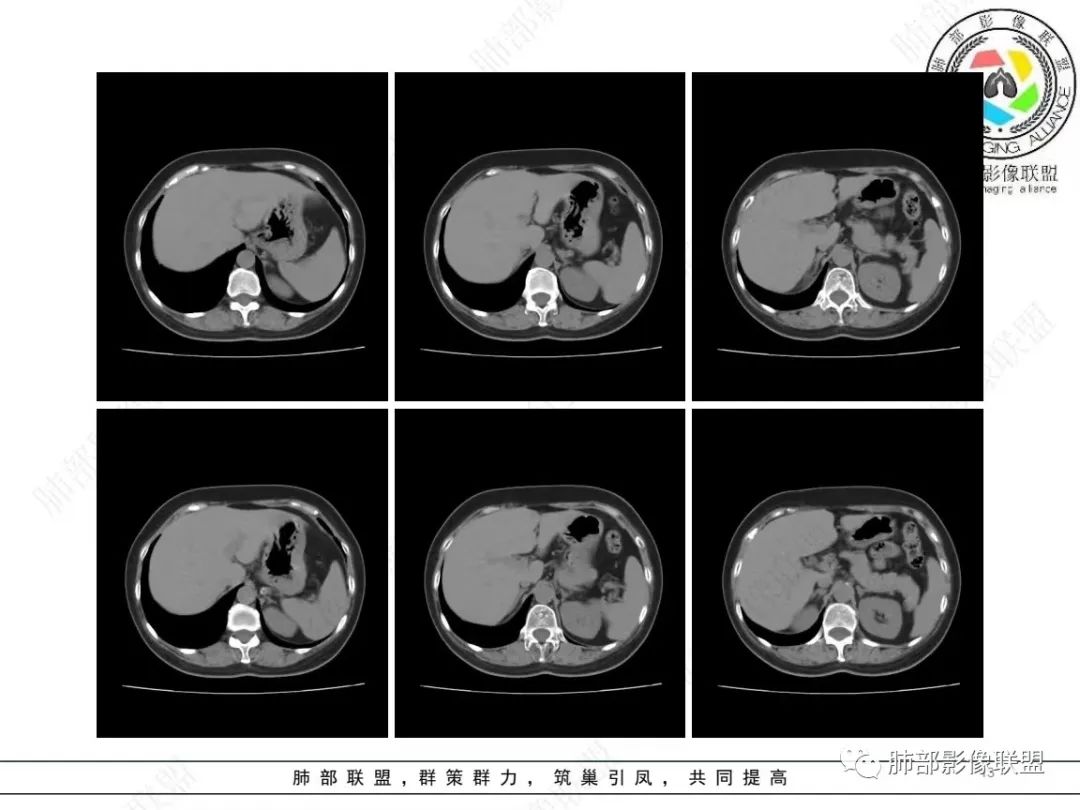 影像PPT - 【病例】 如此扮相的隐球菌,你敢诊断吗?-14 影像PPT - 【病例】 如此扮相的隐球菌,你敢诊断吗?-14