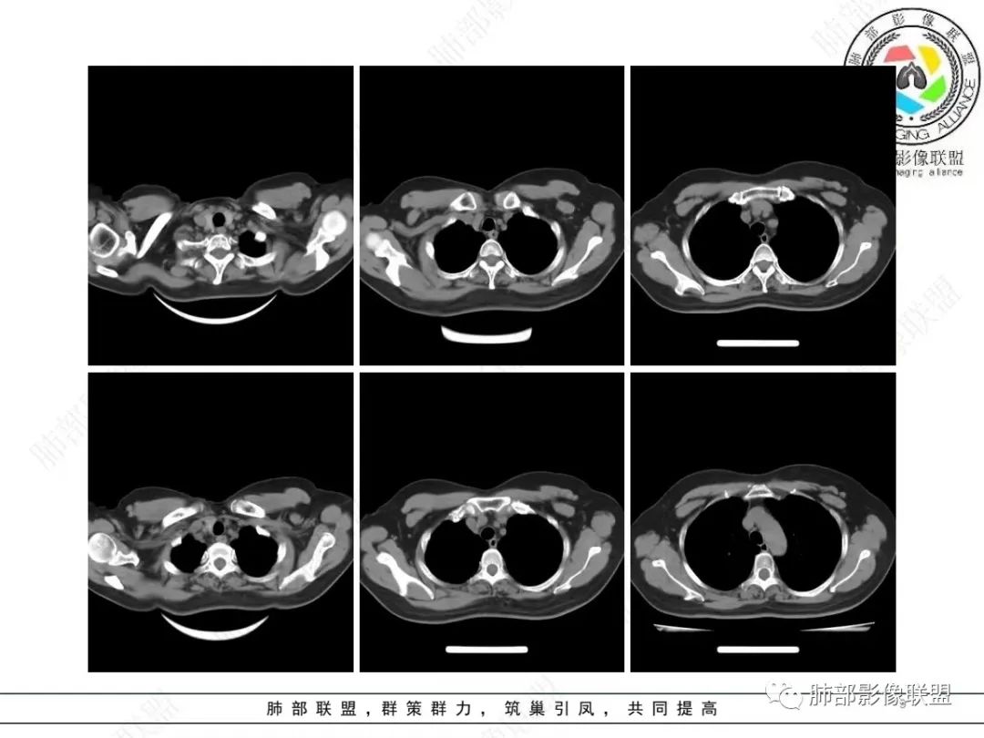 影像PPT - 【病例】 如此扮相的隐球菌,你敢诊断吗?-10 影像PPT - 【病例】 如此扮相的隐球菌,你敢诊断吗?-10