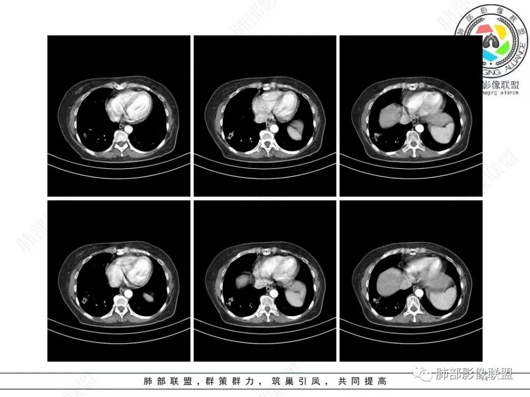 影像PPT - 【病例】 如此扮相的隐球菌,你敢诊断吗?-15 影像PPT - 【病例】 如此扮相的隐球菌,你敢诊断吗?-15
