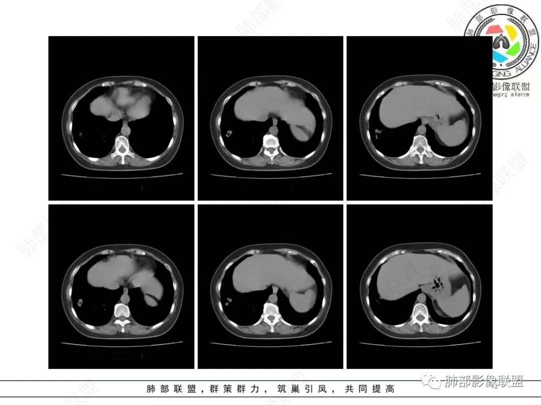 影像PPT - 【病例】 如此扮相的隐球菌,你敢诊断吗?-13 影像PPT - 【病例】 如此扮相的隐球菌,你敢诊断吗?-13