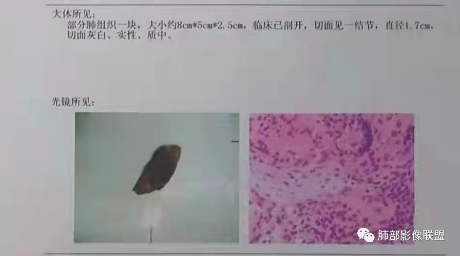 影像PPT - 【病例】 如此扮相的隐球菌,你敢诊断吗?-21 影像PPT - 【病例】 如此扮相的隐球菌,你敢诊断吗?-21