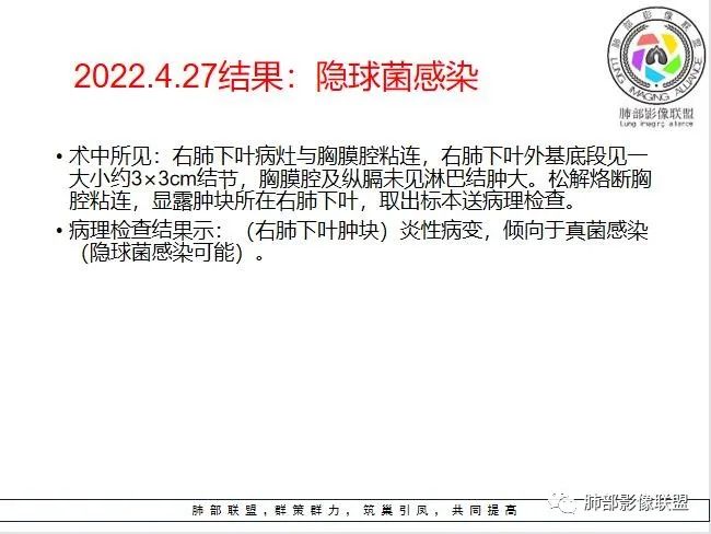 影像PPT - 【病例】 如此扮相的隐球菌,你敢诊断吗?-22 影像PPT - 【病例】 如此扮相的隐球菌,你敢诊断吗?-22