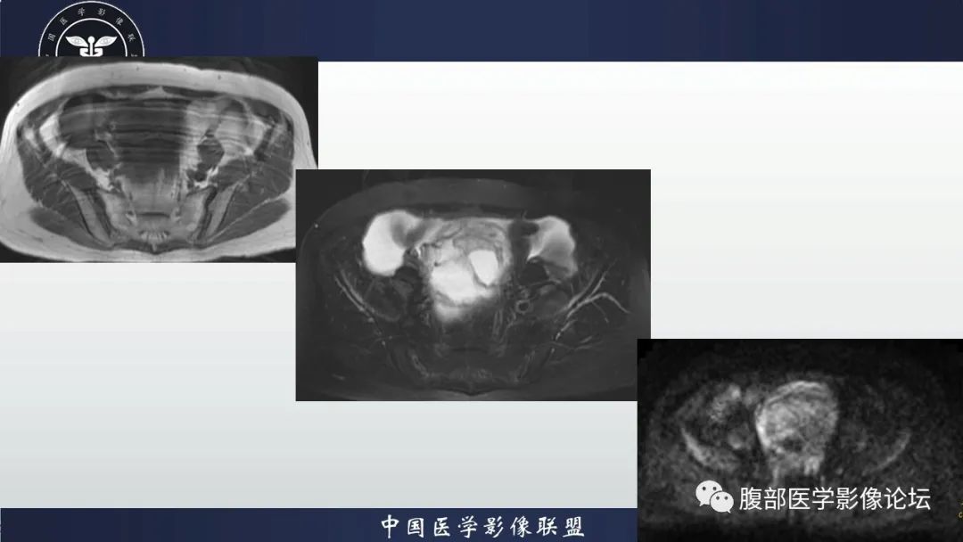 影像PPT - 【病例】卵巢甲状腺肿1里MR影像-3