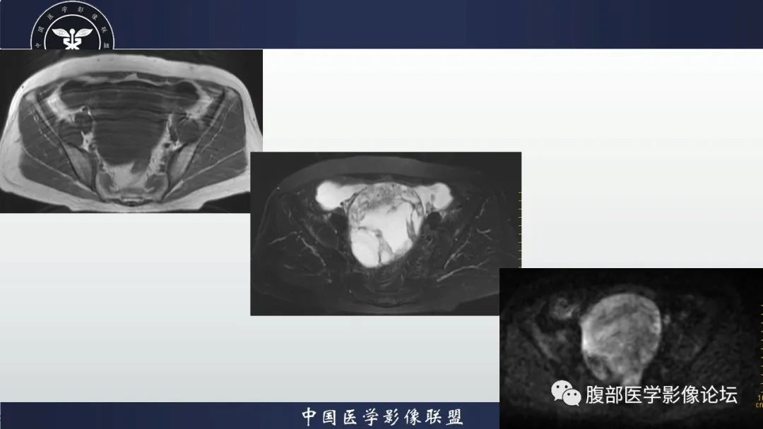 影像PPT - 【病例】卵巢甲状腺肿1里MR影像-4